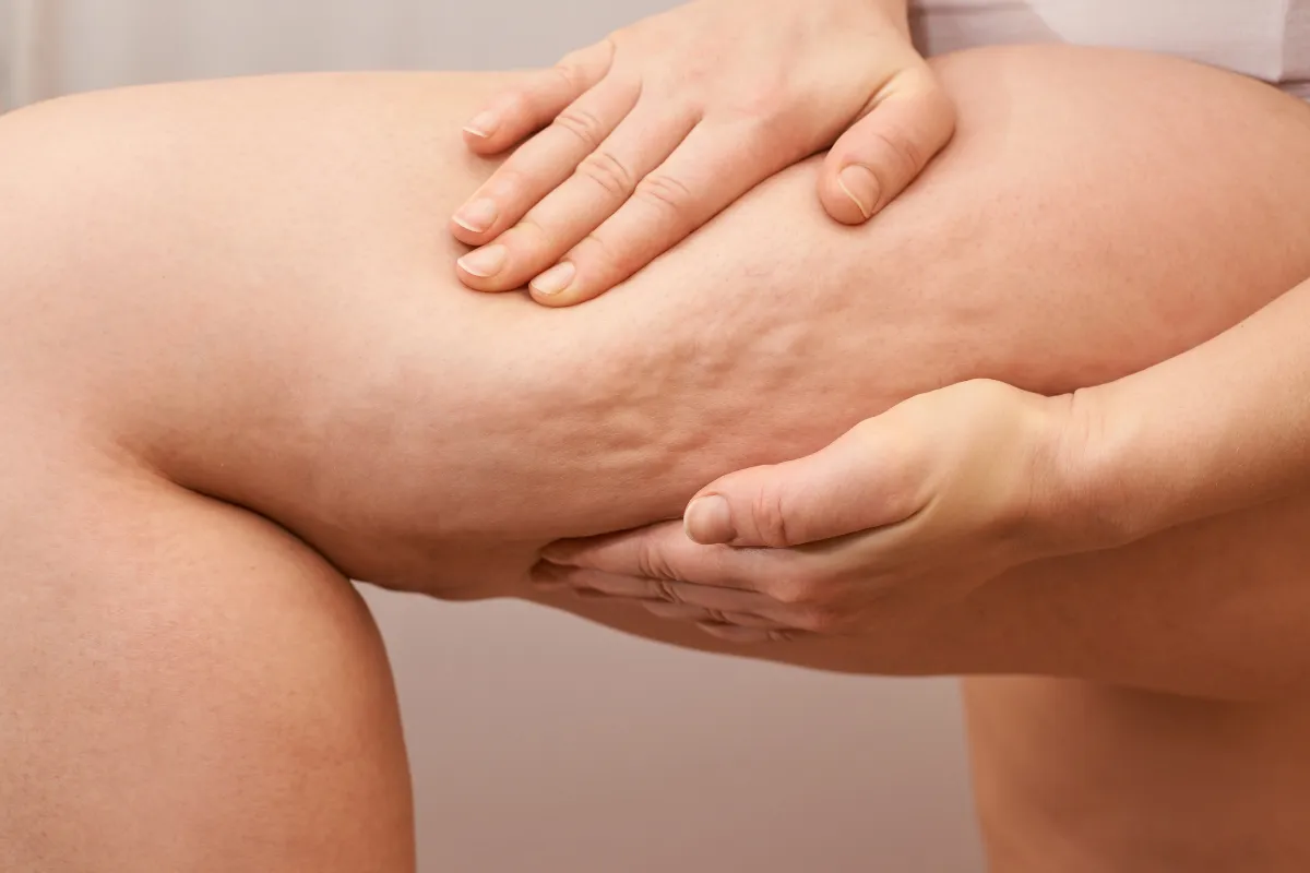Examen médical de la jambe d’une patiente atteinte de lipœdème